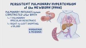 Persistent Pulmonary Hypertension of the Newborn